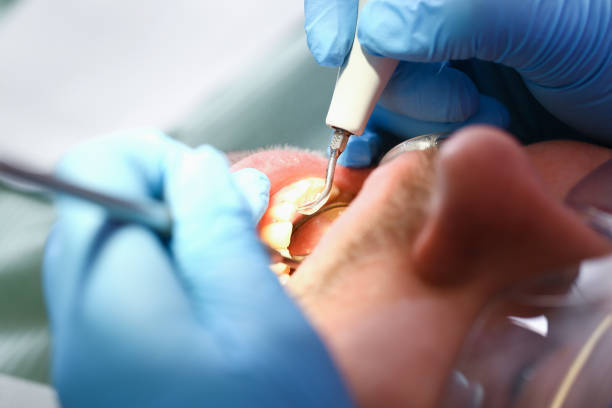 Best Emergency Dentist for Lost Fillings or Crowns in San Saba, TX